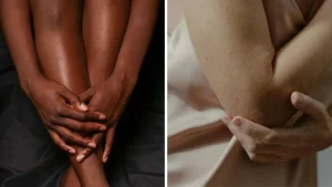 get-rid-of-dark-knees-elbows-natural-pigmentation-hacks