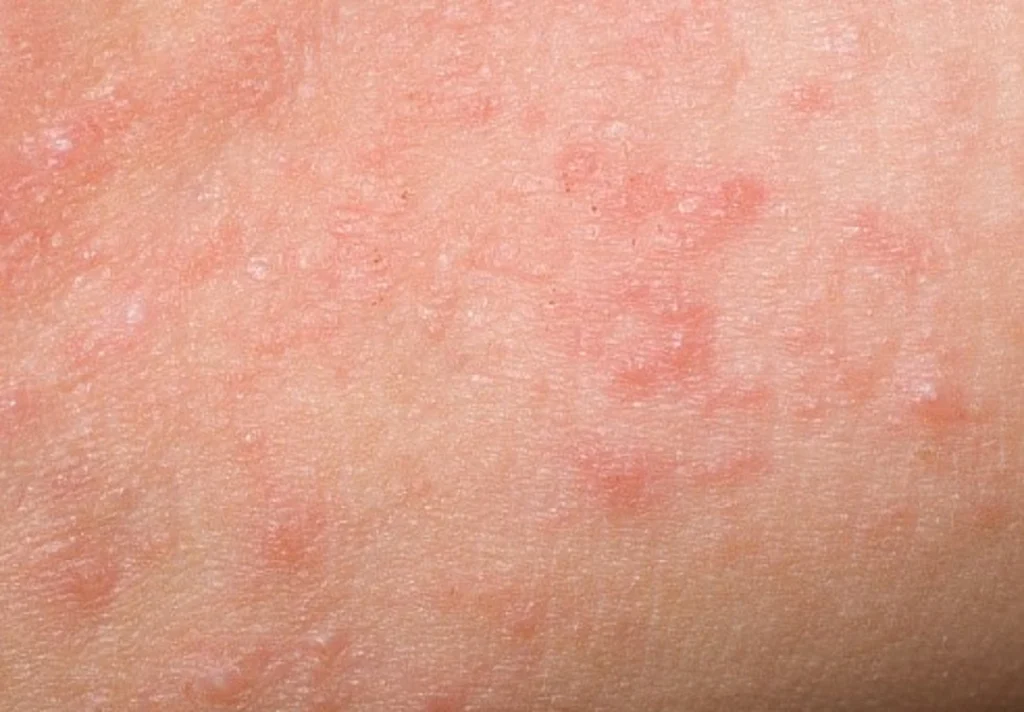 diabetes_3_getty