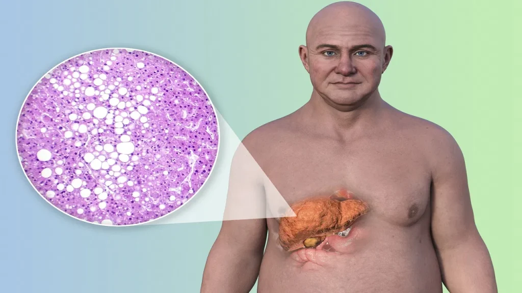 fatty-liver-gettyimages