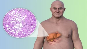 fatty-liver-gettyimages