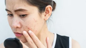 white-pimples