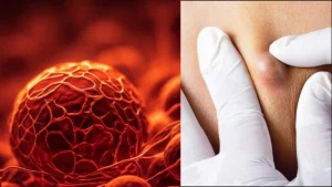 cancer-lumps-pain-10-06-2025-1749557486