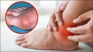 high-uric-acid-symptoms-17-06-2025-1750133269