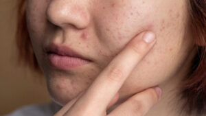 red-spots-thumb