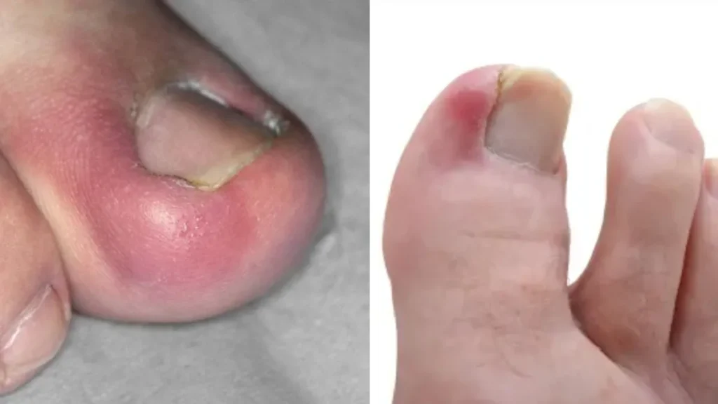 toenail-grow-inside-17-06-2025-1750157518
