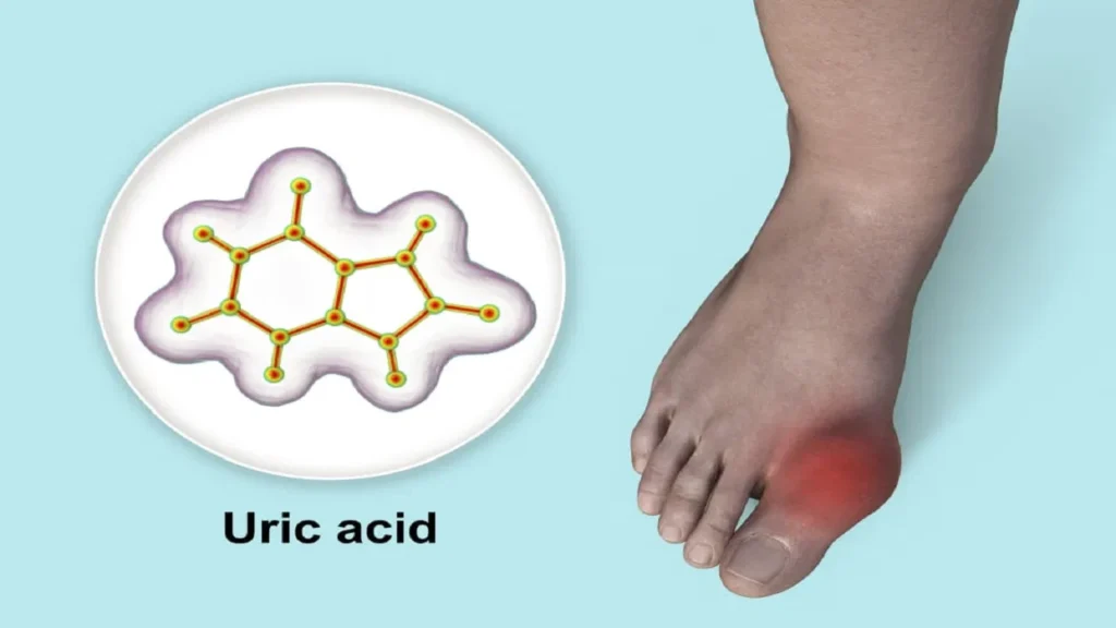 uric-acid