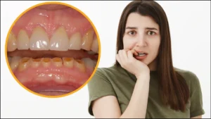 tooth-decay-29-07-2025-1753772159