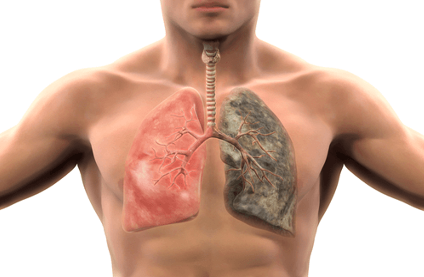 1574749290-Lungscancer