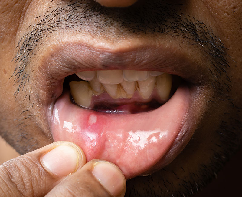 21766-mouth-ulcer