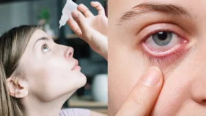 conjunctivitis-treatment-18-08-2025-1755482643