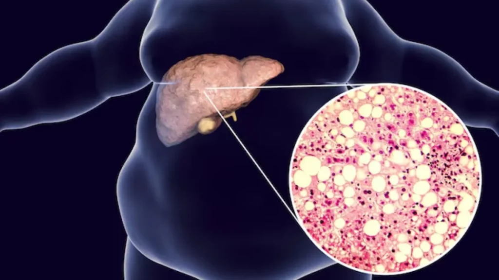 fatty-liver-cause-cancer-15-08-2025-1755237947