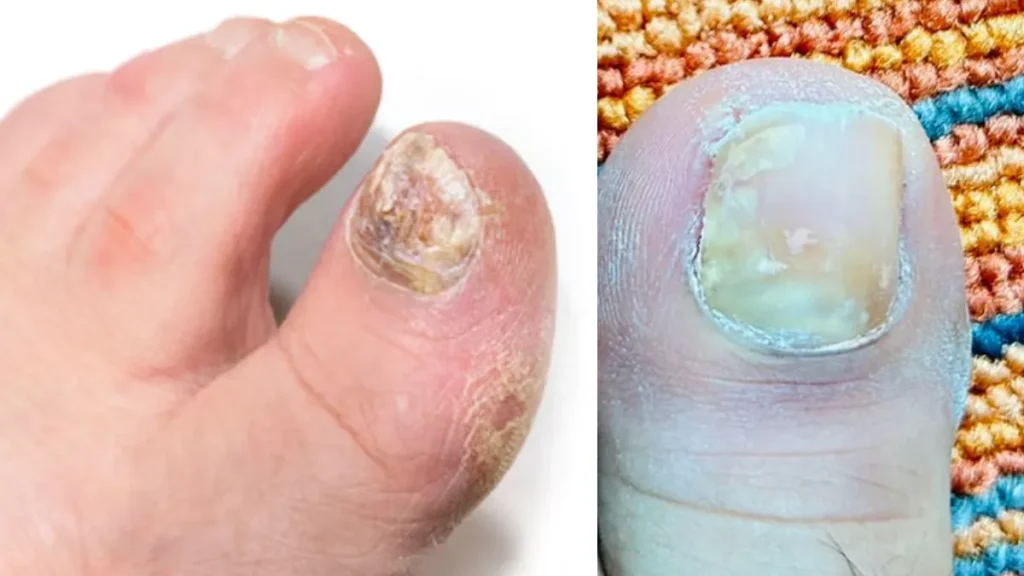 toenail-infection-remedy-19-08-2025-1755569586