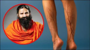 veins-health-ramdev-01-08-2025-1754025085