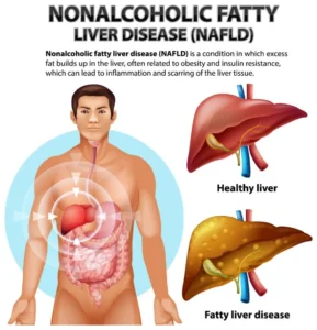 NAFLD-987x1024-optimized