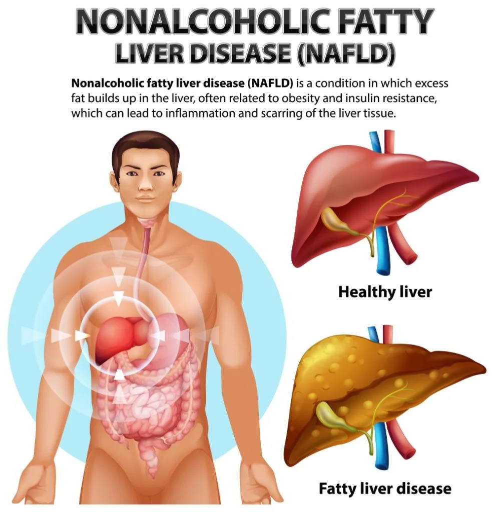 NAFLD-987x1024-optimized