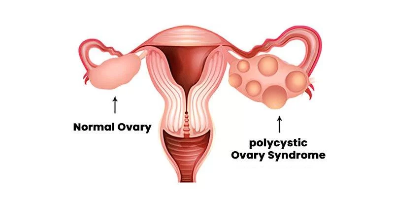 pcos