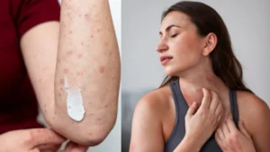 pitti-home-remedies-18-09-2025-1758197947