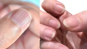 lines-on-nail-problem-16-10-2025-1760601524