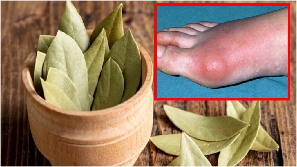 uric-acid-gout-tej-patta-30-10-2025-1761789715