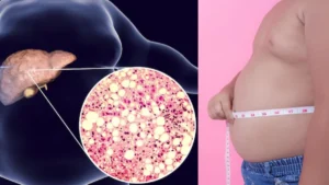 fatty-liver-symptoms-19-11-2025-1763515328